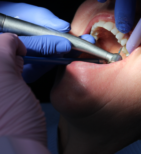 Can Composite Bonding Fix Chipped or Crooked Teeth? Here’s Everything You Need to Know