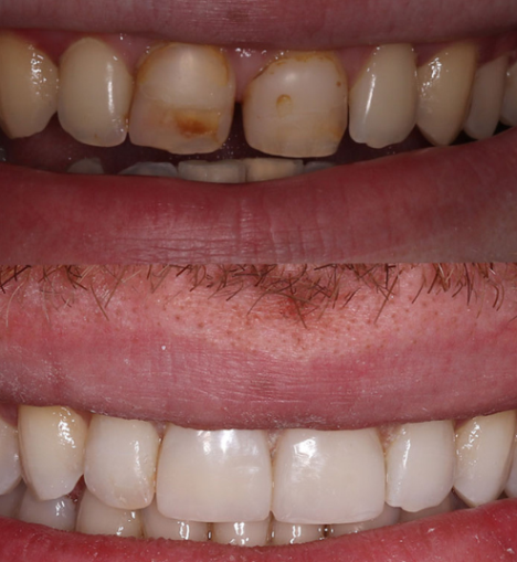 Is Professional Teeth Whitening Worth the Investment? Here’s What You Need to Know