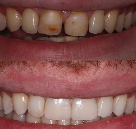 Is Professional Teeth Whitening Worth the Investment? Here’s What You Need to Know