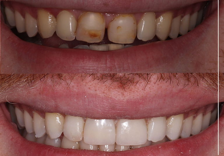 Is Professional Teeth Whitening Worth the Investment? Here’s What You Need to Know