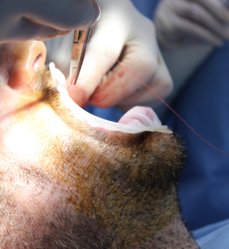 Top 10 Questions to Ask Before Getting Dental Implants