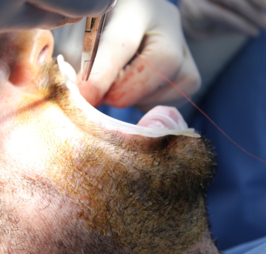 Top 10 Questions to Ask Before Getting Dental Implants